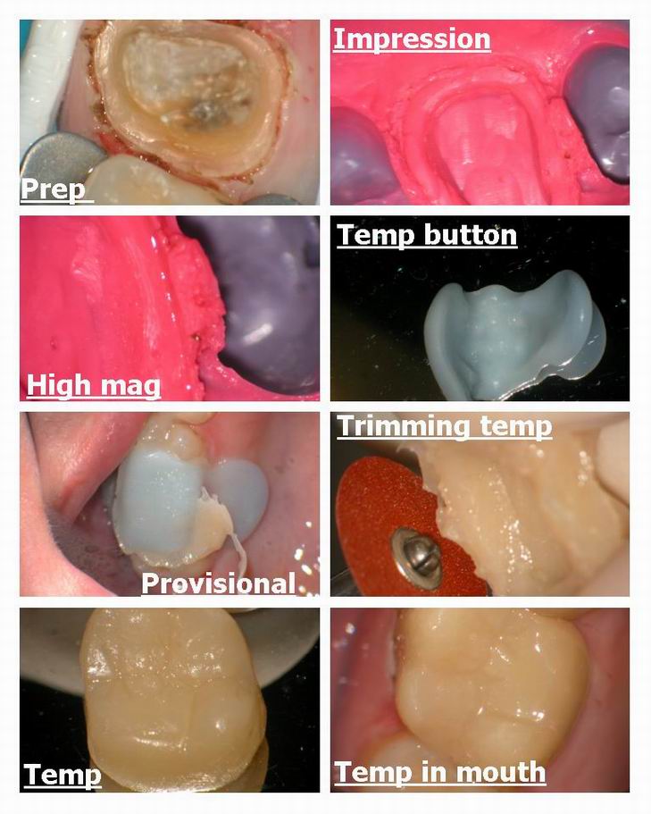 Resize of Pg 5 of crown prep.jpg